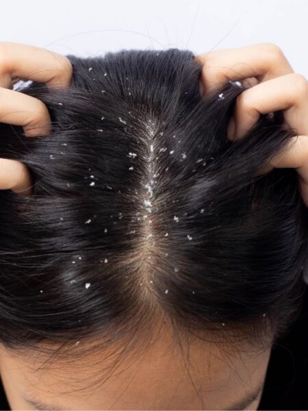 caspa couro cabeludo - dematite seborreica