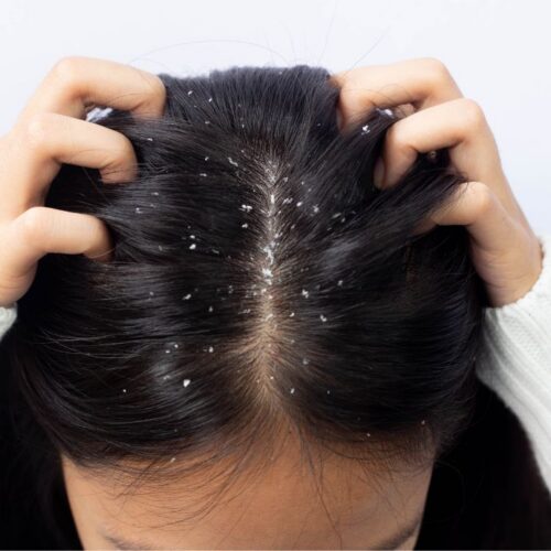 caspa couro cabeludo - dematite seborreica