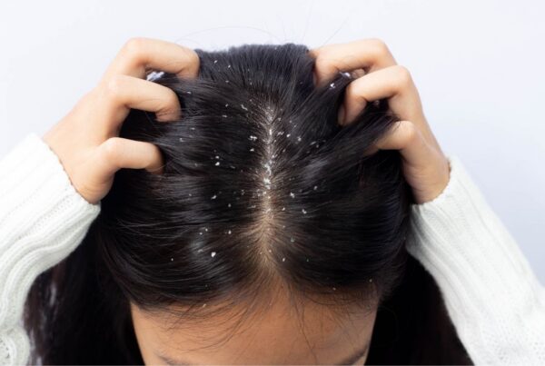 caspa couro cabeludo - dematite seborreica